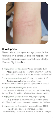 Model Dermatol ডাউনলোড করুন – চর্মরোগ শনাক্তকরণের সেরা অ্যাপ - Screenshot 7